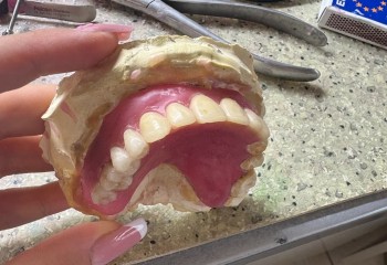 Zdjęcie przedstawia wykonaną pracę protetyczną