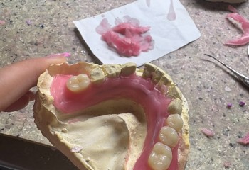 Zdjęcie przedstawia wykonaną pracę protetyczną